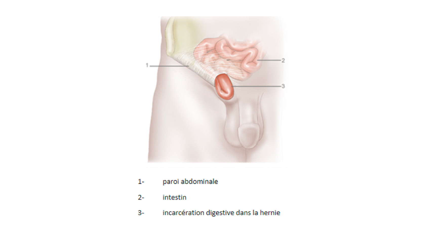 Traitement de l'hernie inguinale - Urologue Dole